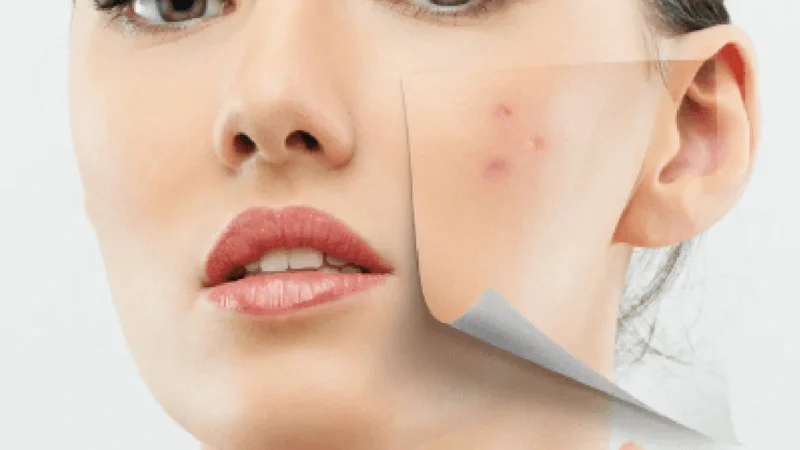 Acne Scar Treatments and Medications